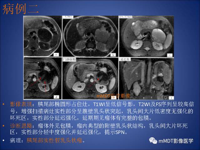 【PPT】胰腺实性假乳头状瘤诊断及鉴别