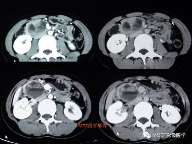 【PPT】胰腺实性假乳头状瘤诊断及鉴别