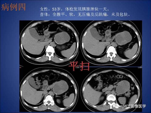 【PPT】胰腺实性假乳头状瘤诊断及鉴别