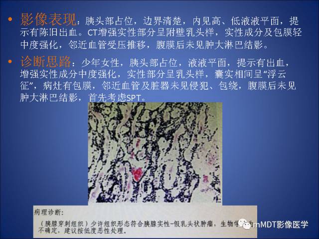 【PPT】胰腺实性假乳头状瘤诊断及鉴别