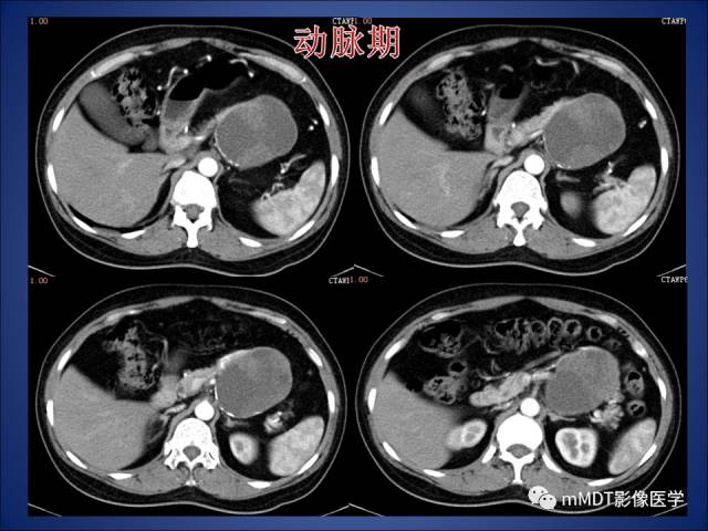 【PPT】胰腺实性假乳头状瘤诊断及鉴别