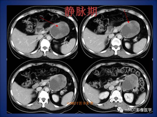 【PPT】胰腺实性假乳头状瘤诊断及鉴别