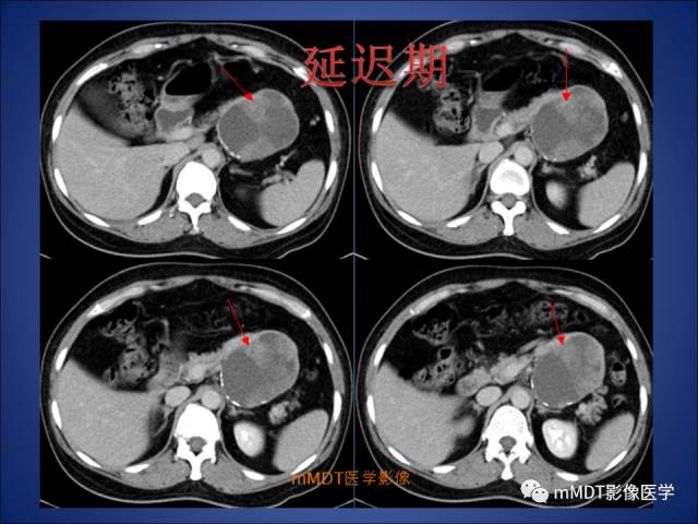 【PPT】胰腺实性假乳头状瘤诊断及鉴别
