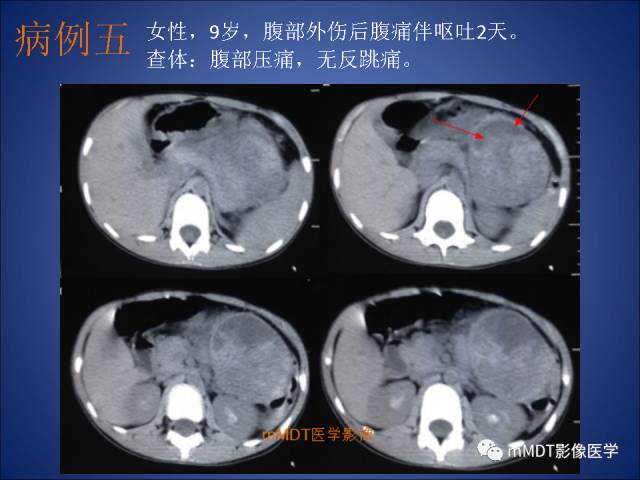 【PPT】胰腺实性假乳头状瘤诊断及鉴别