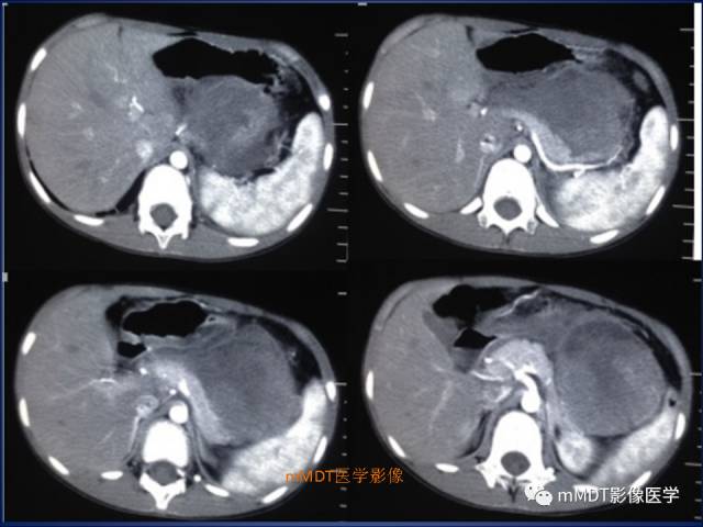 【PPT】胰腺实性假乳头状瘤诊断及鉴别