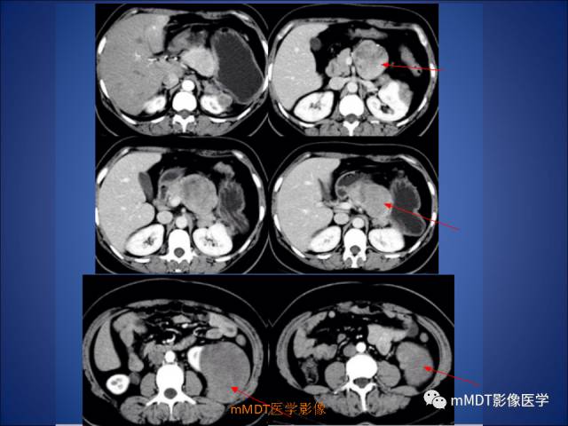 【PPT】胰腺实性假乳头状瘤诊断及鉴别