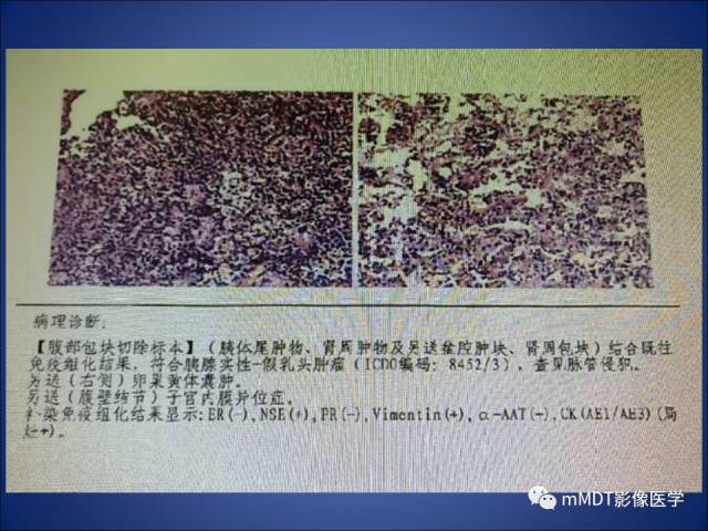 【PPT】胰腺实性假乳头状瘤诊断及鉴别