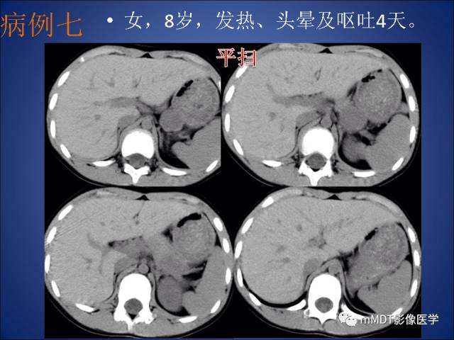 【PPT】胰腺实性假乳头状瘤诊断及鉴别