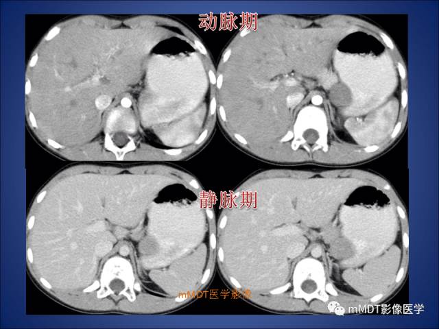 【PPT】胰腺实性假乳头状瘤诊断及鉴别