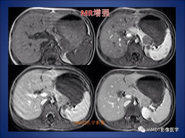 【PPT】胰腺实性假乳头状瘤诊断及鉴别