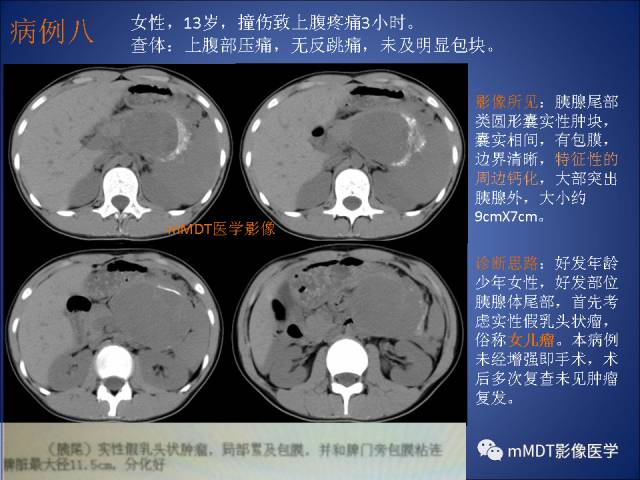 【PPT】胰腺实性假乳头状瘤诊断及鉴别