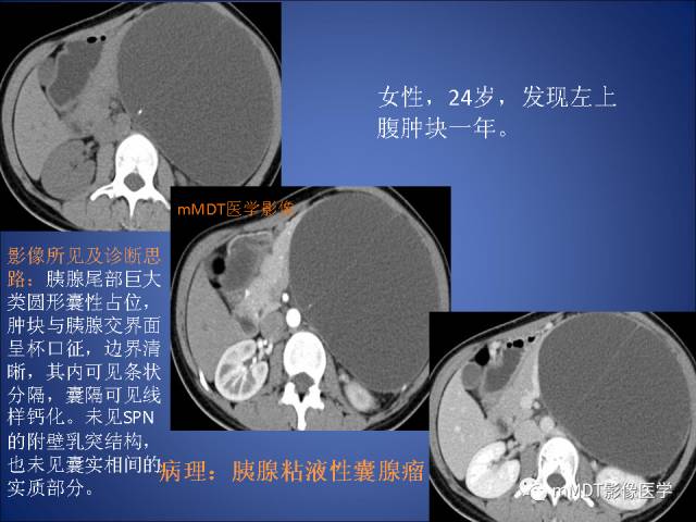 【PPT】胰腺实性假乳头状瘤诊断及鉴别