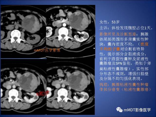 【PPT】胰腺实性假乳头状瘤诊断及鉴别
