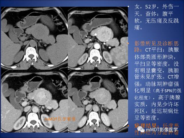 【PPT】胰腺实性假乳头状瘤诊断及鉴别