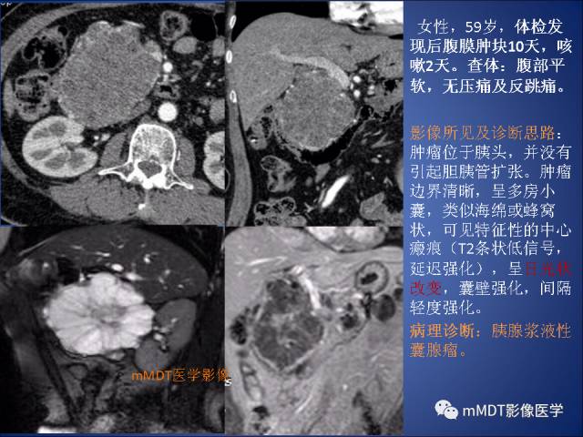 【PPT】胰腺实性假乳头状瘤诊断及鉴别