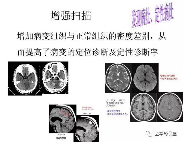 【PPT】脑肿瘤CT和MR诊断和鉴别诊断