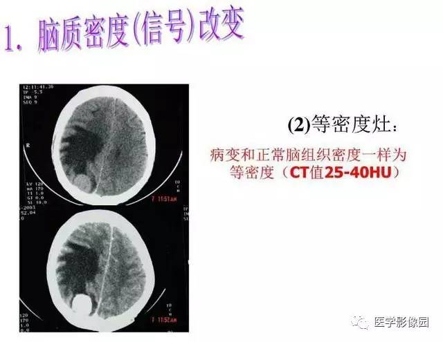 【PPT】脑肿瘤CT和MR诊断和鉴别诊断