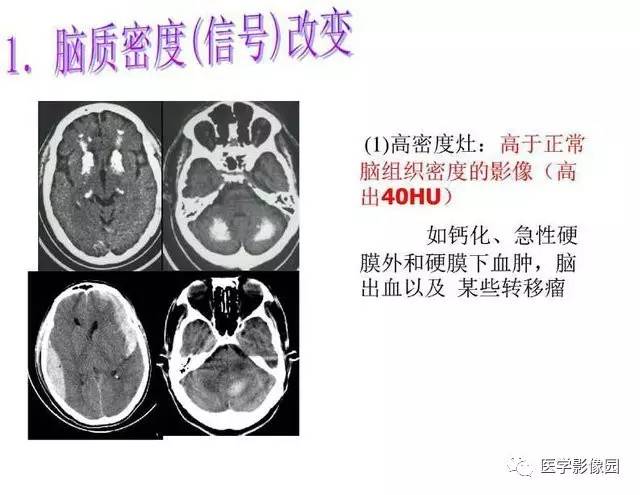 【PPT】脑肿瘤CT和MR诊断和鉴别诊断