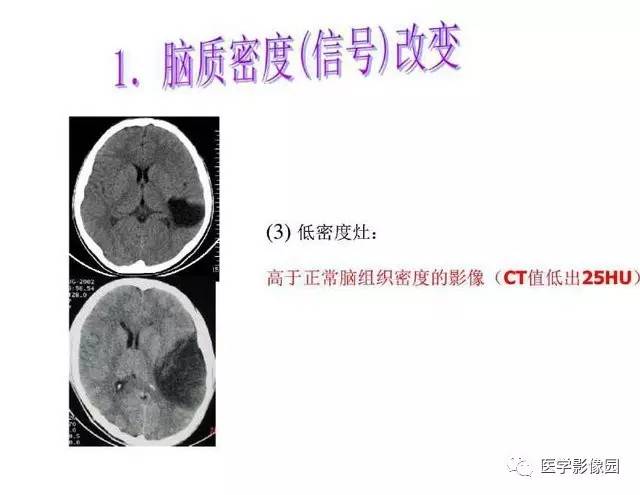 【PPT】脑肿瘤CT和MR诊断和鉴别诊断