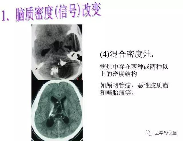 【PPT】脑肿瘤CT和MR诊断和鉴别诊断