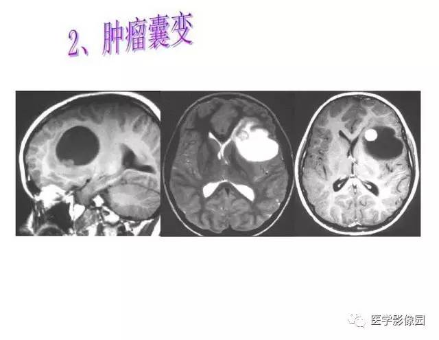 【PPT】脑肿瘤CT和MR诊断和鉴别诊断