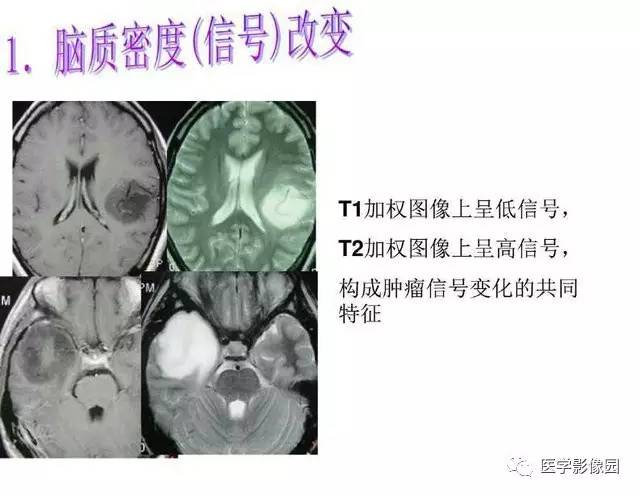 【PPT】脑肿瘤CT和MR诊断和鉴别诊断