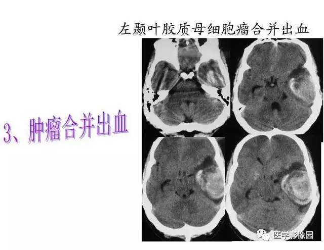 【PPT】脑肿瘤CT和MR诊断和鉴别诊断