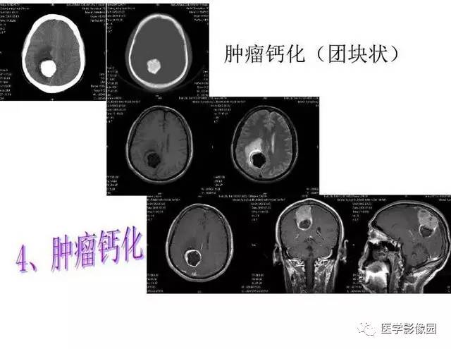 【PPT】脑肿瘤CT和MR诊断和鉴别诊断