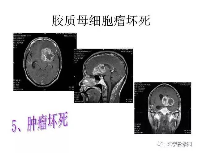 【PPT】脑肿瘤CT和MR诊断和鉴别诊断