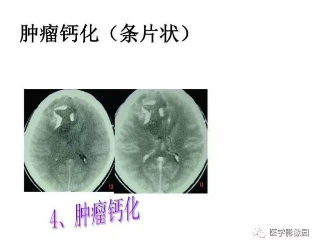 【PPT】脑肿瘤CT和MR诊断和鉴别诊断
