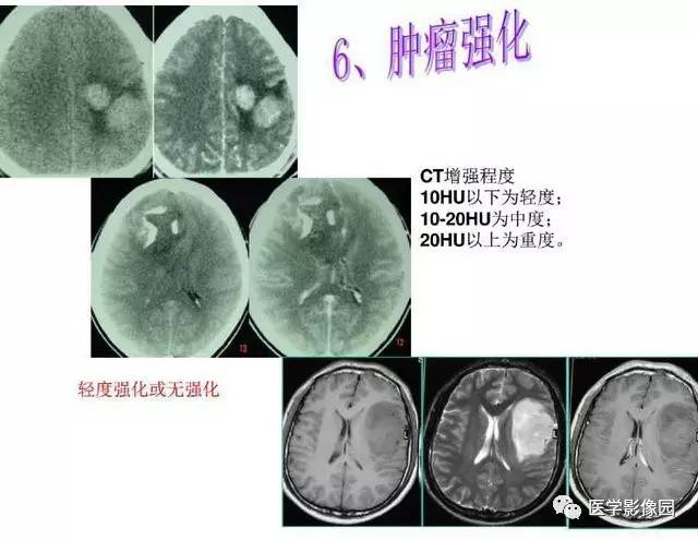 【PPT】脑肿瘤CT和MR诊断和鉴别诊断