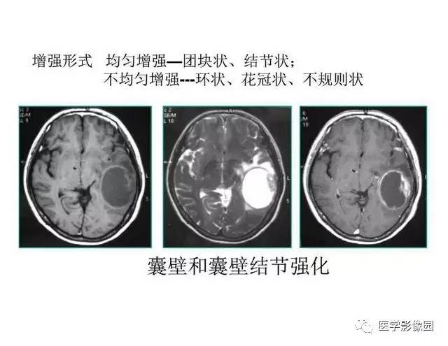 【PPT】脑肿瘤CT和MR诊断和鉴别诊断