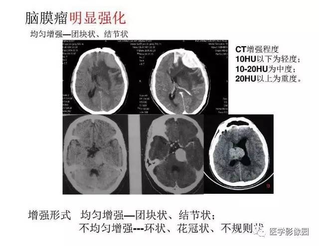 【PPT】脑肿瘤CT和MR诊断和鉴别诊断