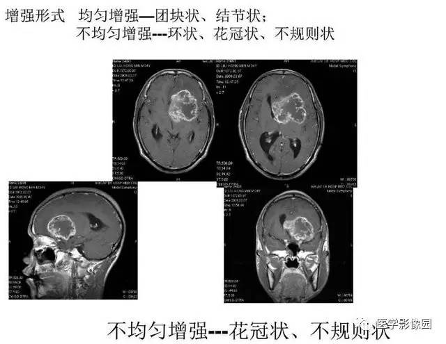 【PPT】脑肿瘤CT和MR诊断和鉴别诊断