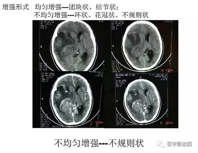 【PPT】脑肿瘤CT和MR诊断和鉴别诊断