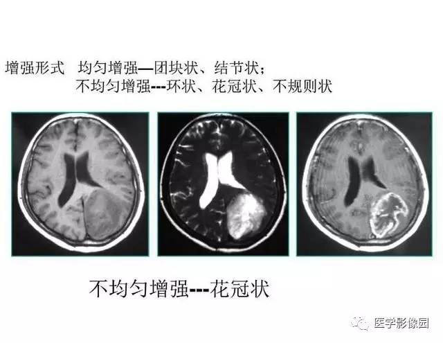 【PPT】脑肿瘤CT和MR诊断和鉴别诊断
