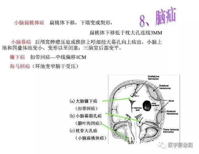 【PPT】脑肿瘤CT和MR诊断和鉴别诊断