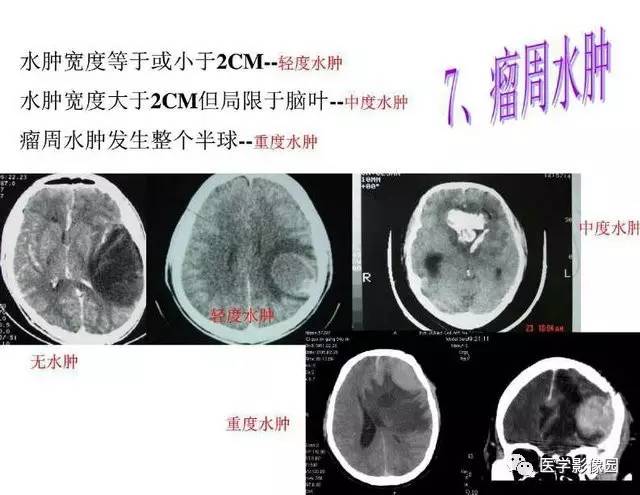 【PPT】脑肿瘤CT和MR诊断和鉴别诊断