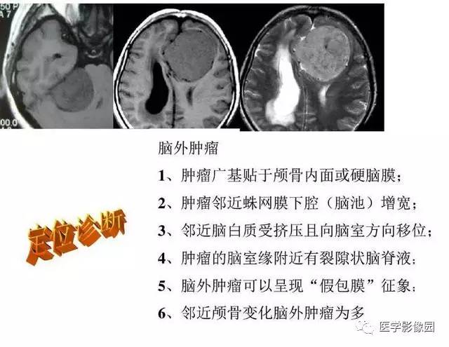 【PPT】脑肿瘤CT和MR诊断和鉴别诊断