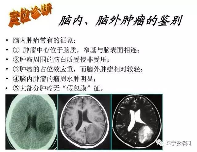 【PPT】脑肿瘤CT和MR诊断和鉴别诊断