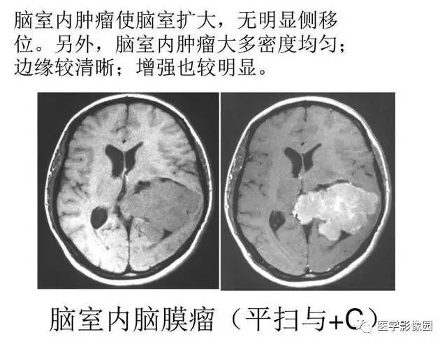 【PPT】脑肿瘤CT和MR诊断和鉴别诊断