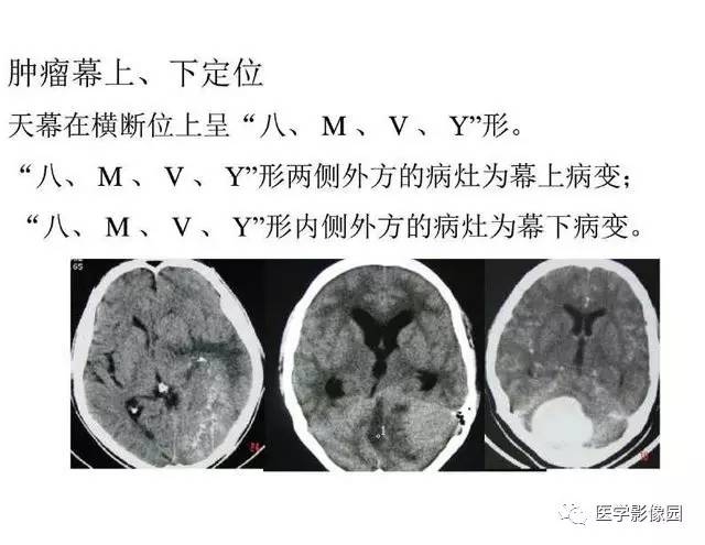 【PPT】脑肿瘤CT和MR诊断和鉴别诊断
