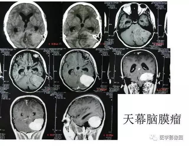 【PPT】脑肿瘤CT和MR诊断和鉴别诊断