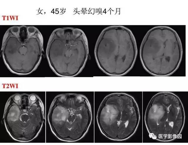 【PPT】脑肿瘤CT和MR诊断和鉴别诊断