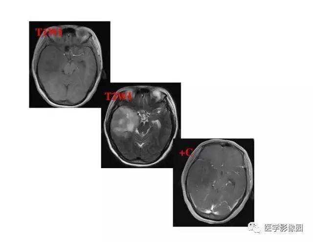 【PPT】脑肿瘤CT和MR诊断和鉴别诊断