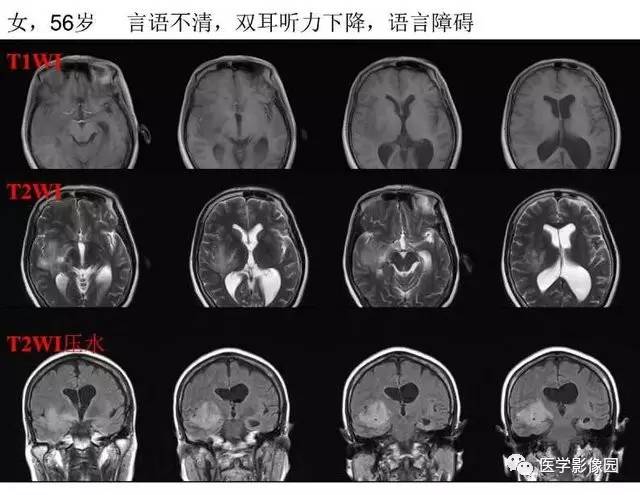 【PPT】脑肿瘤CT和MR诊断和鉴别诊断