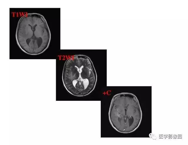 【PPT】脑肿瘤CT和MR诊断和鉴别诊断