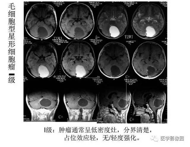 【PPT】脑肿瘤CT和MR诊断和鉴别诊断