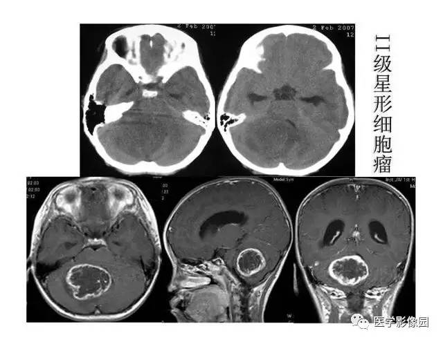 【PPT】脑肿瘤CT和MR诊断和鉴别诊断