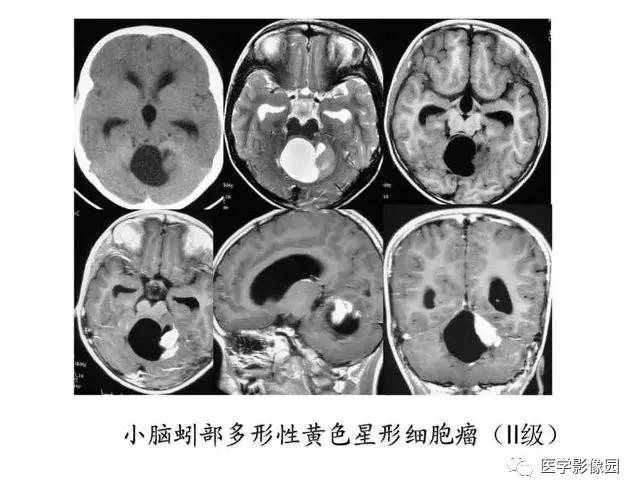 【PPT】脑肿瘤CT和MR诊断和鉴别诊断
